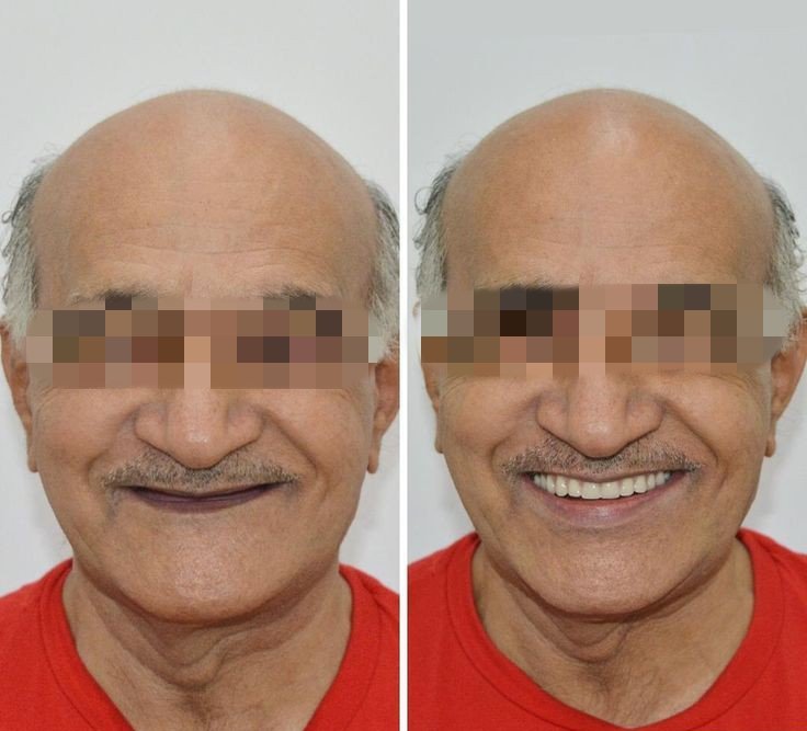 Before and after dental treatment result - IMG_20240125_173216.jpg