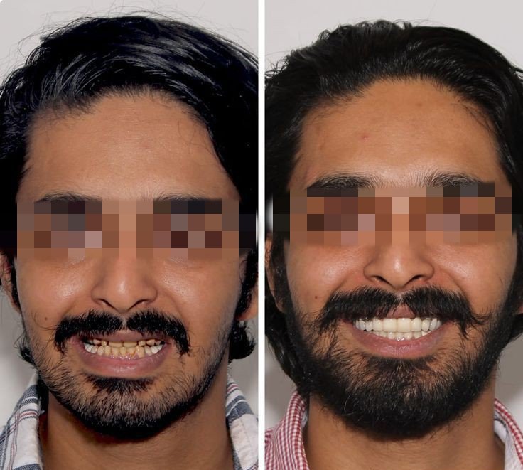 Before and after dental treatment result - IMG_20240125_173344.jpg