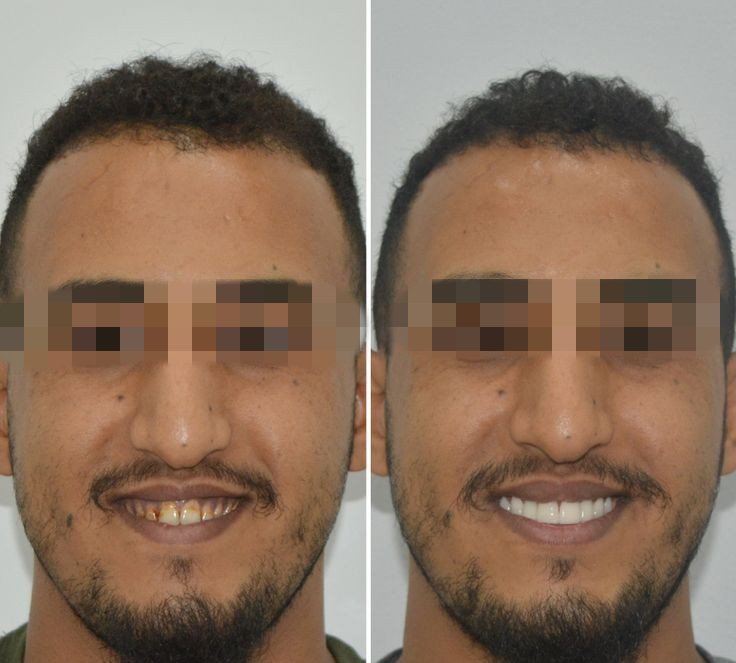 Before and after dental treatment result - IMG_20240125_173411.jpg