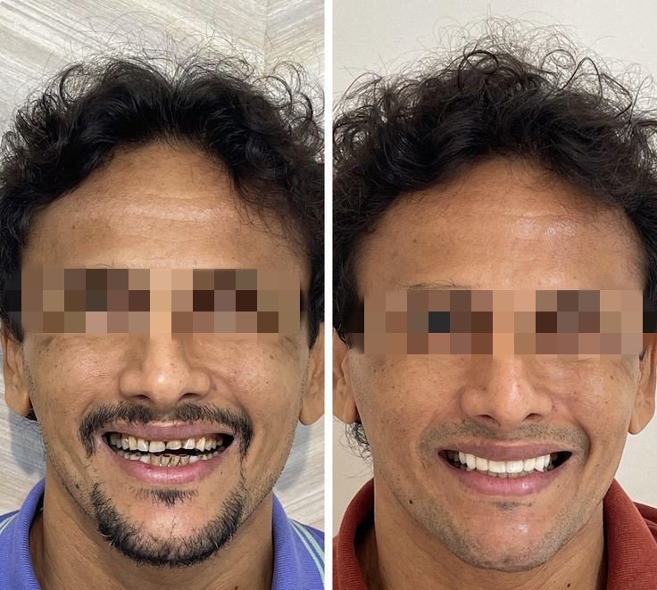 Before and after dental treatment result - IMG_20240125_173556.jpg